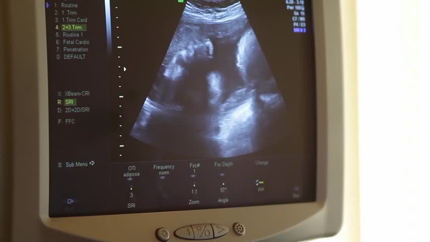 Medical Ultrasound Scan Of Human Embryo. On The Computer Monitor, You ...